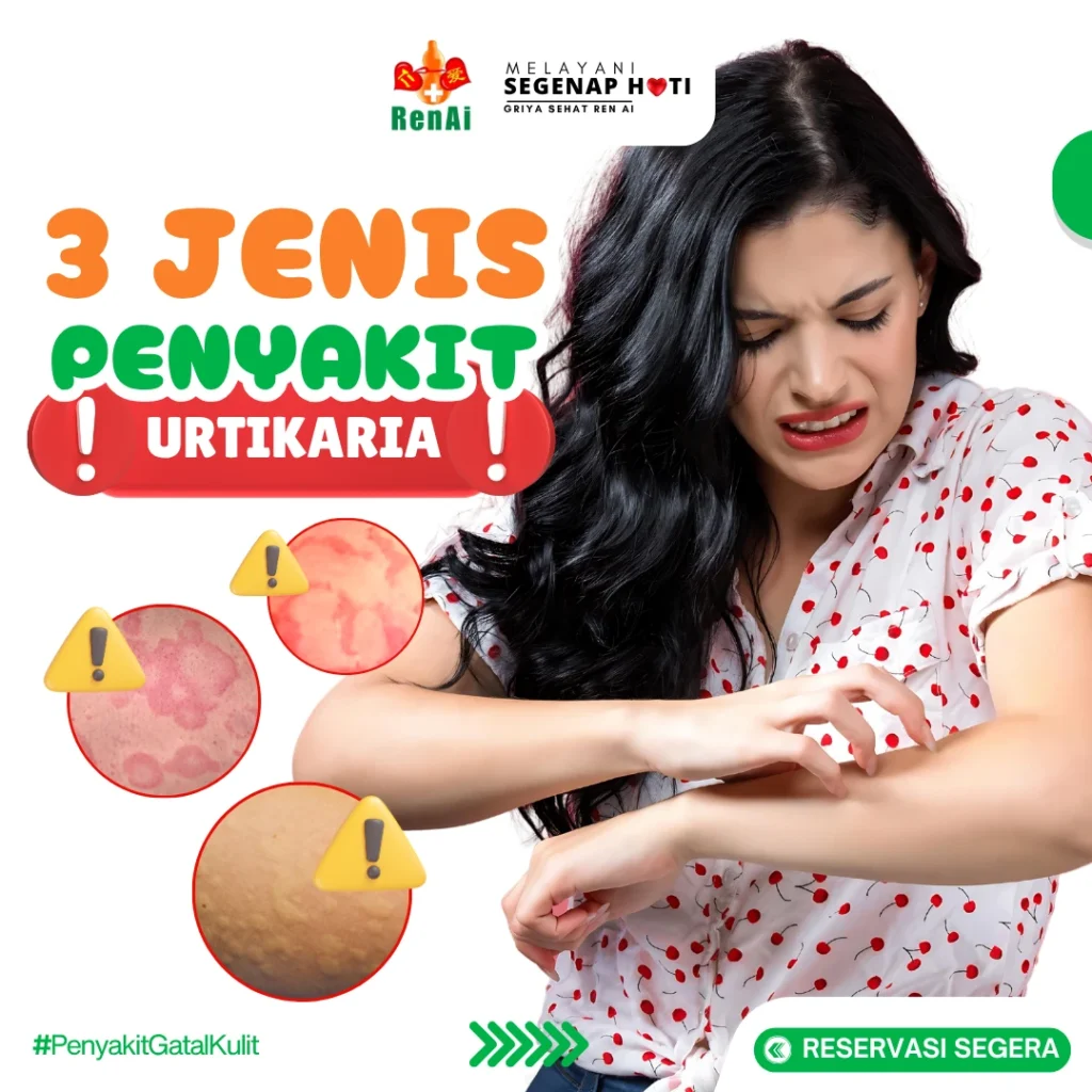 3 Jenis penyakit urtikaria