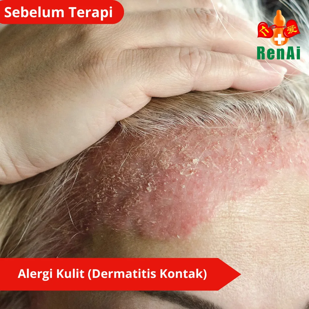 Alergi Kulit, (Dermatitis Kontak)