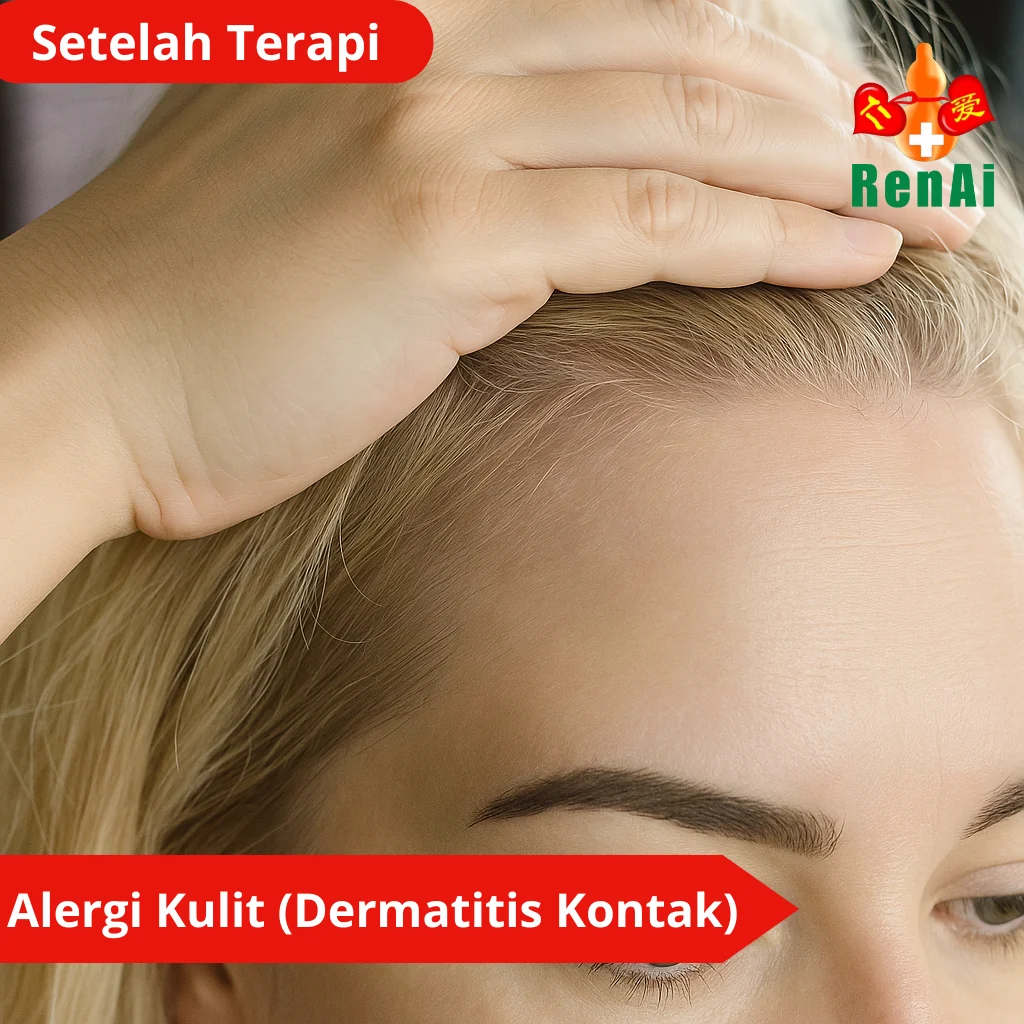 Alergi Kulit (Dermatitis Kontak)