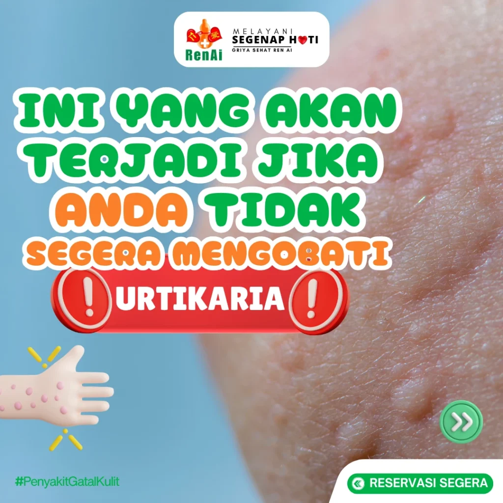 Mengobati Penyakit Urtikaria