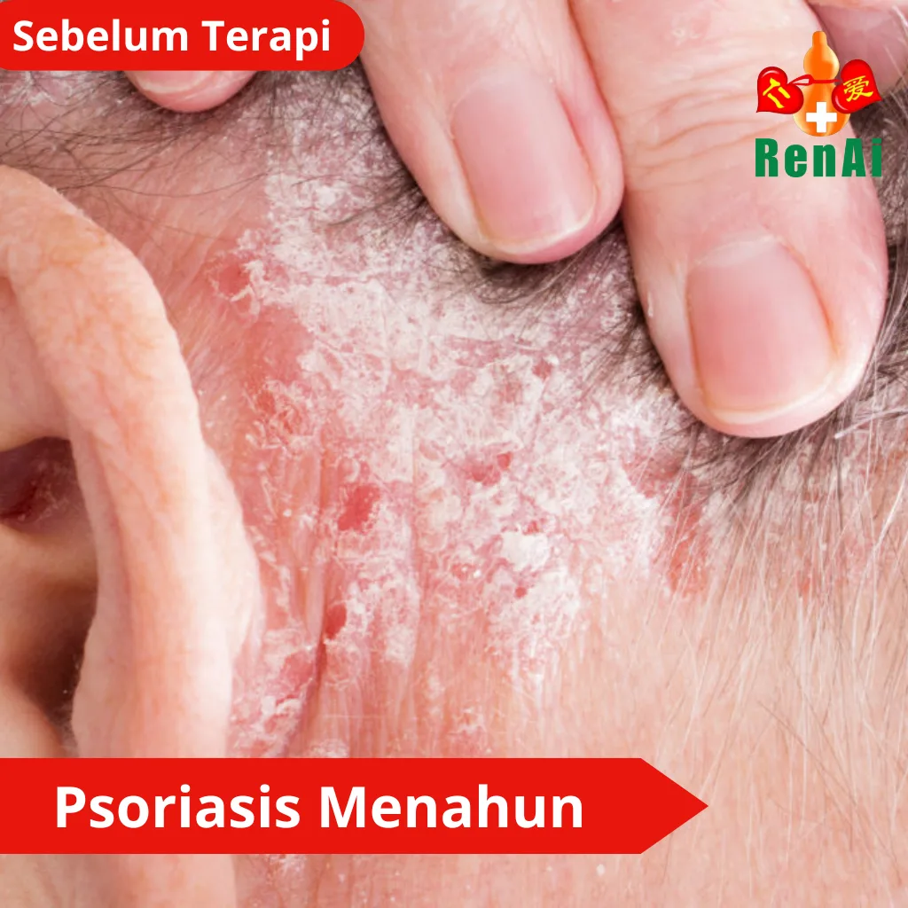 Psoriasis Menahun