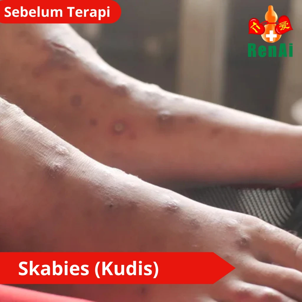 Skabies (penyakit kudis kudis)